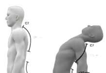 “정확한 평가가 척추측만증 교정의 첫걸음”